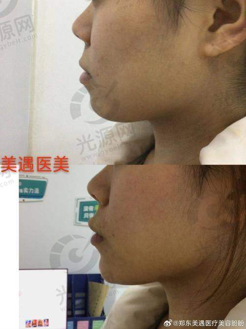 如何有效避免假体下巴上移