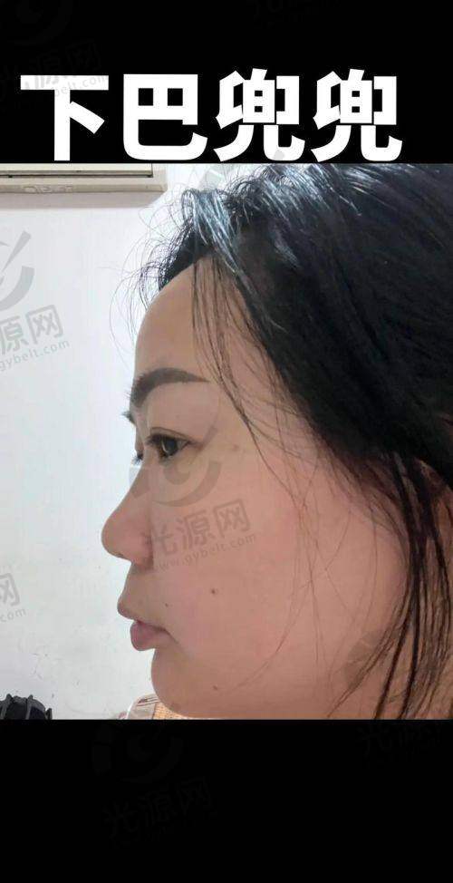 假体下巴上移后可进行的修复方法