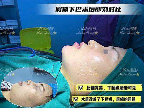 假体下巴上移的主要影响因素