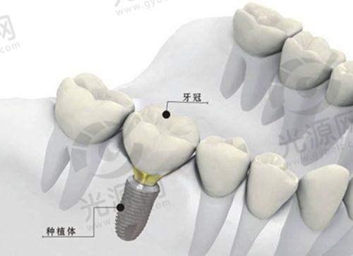 费用对比登特斯和奥齿泰哪个好