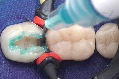 深龋的潜在危害