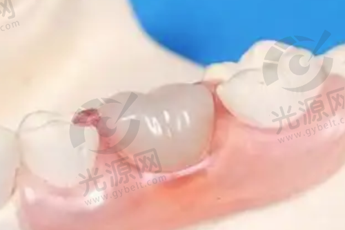 深龋的专精修复处理