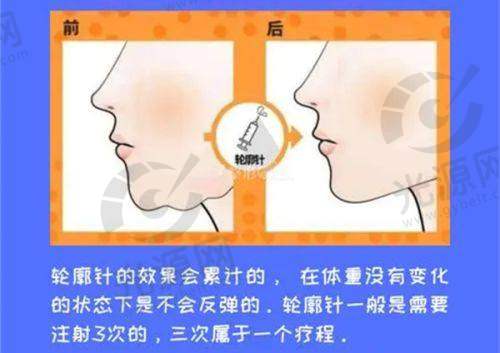 新疆华美整形医院韩式提眉手术排名第1：吴新民医生