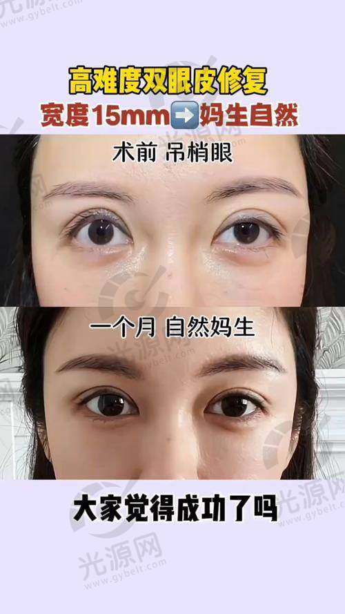 四、重庆双眼皮做的好的医生口碑评价
