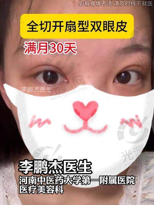 重庆双眼皮做的好的医生排名第2：董开云医生