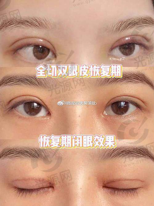 重庆双眼皮做的好的医生排名第8：谢锦清医生