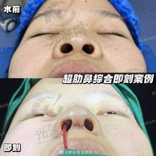 成都出名的做鼻子医生推荐：周柯、刘祎等五位口碑优秀的隆鼻专家排行分析与技术优势解析