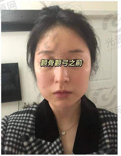 怎样评估一边脸颧骨高一边低的重度程度