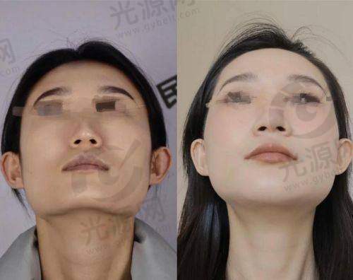 非手术方法改善颧骨不对称