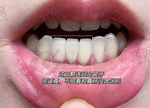 格莱美牙冠的市场反馈与实际实例
