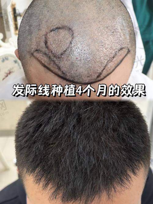 三、西宁植发价格说明