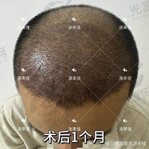 上海新生植发医院哪个医生做的好？上海新生植发医院医生推荐与植发技术优势，助你重拾浓密秀发！