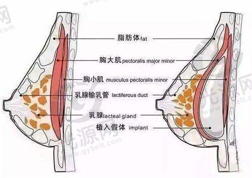 胸部韧带提升术技术成熟