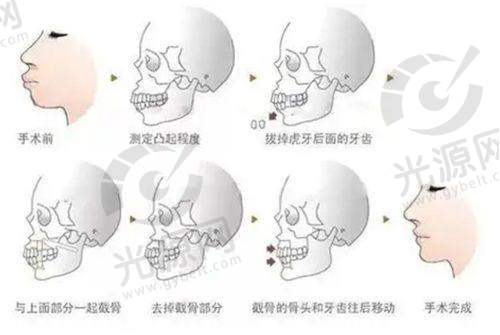 泪腺脱垂与提眉的关系