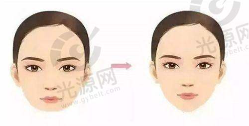 光子嫩肤的作用与间隔时间