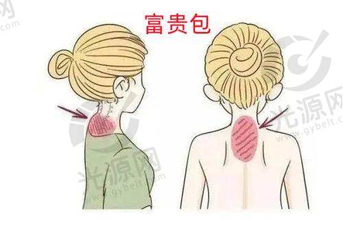 二、通化地区鼻翼缩小手术收费情况