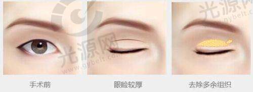 光子嫩肤的基本认识与作用