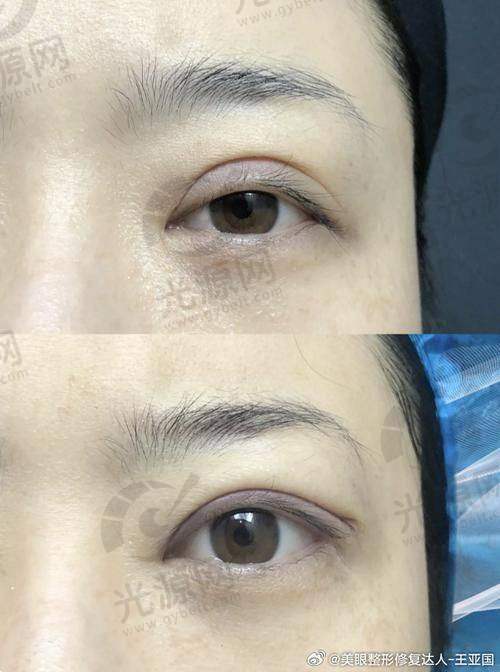宋蔚医生的美杜莎4.0技术：眼部整形的黑科技