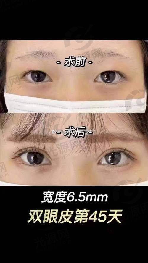 西安艺星整形医院宋蔚好不好？宋蔚技术高超，自然效果显著，选择她让你美丽无忧！