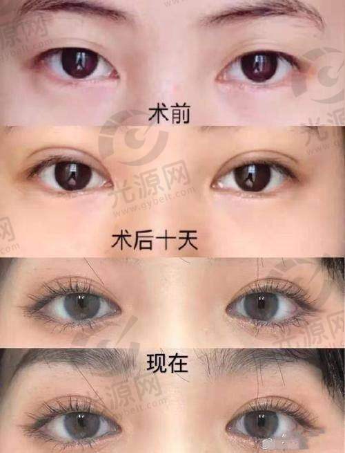 做纳米无痕双眼皮的基本费用