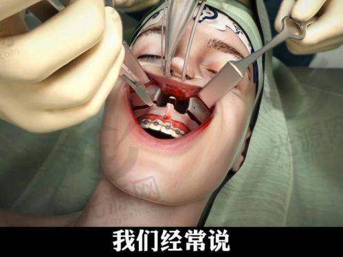 正颌手术毁我一辈子：心理准备与期待管理