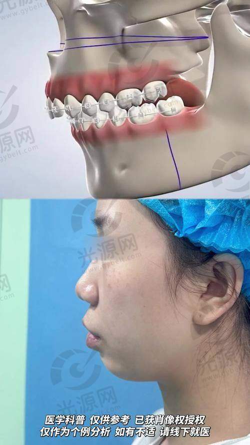 正颌手术毁我一辈子：年纪与身体状况的考虑