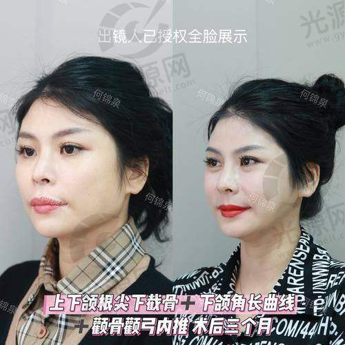 正颌手术毁我一辈子：术后护理的忽视