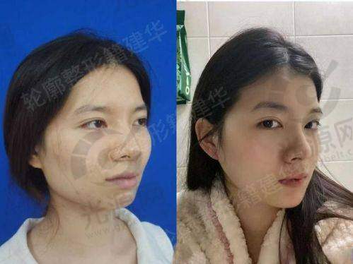 去韩国削下颌骨男性术后成效期待