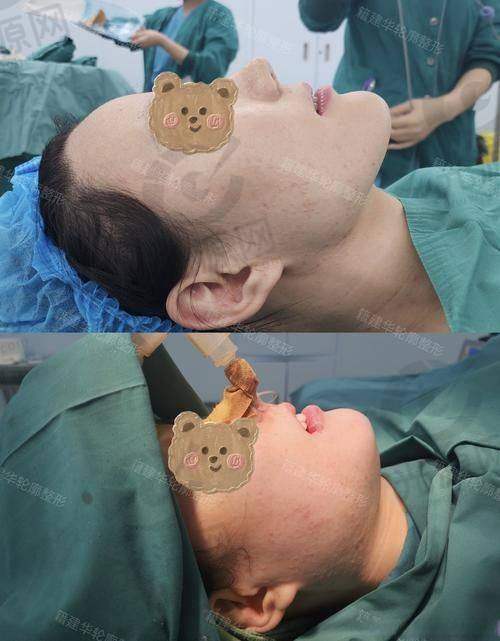 去韩国削下颌骨男性选择医院的重要性
