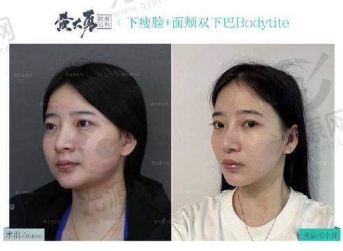 去韩国削下颌骨男性总结