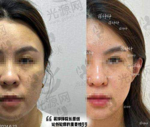 韩国6d小脸针多少钱一支：总结与建议