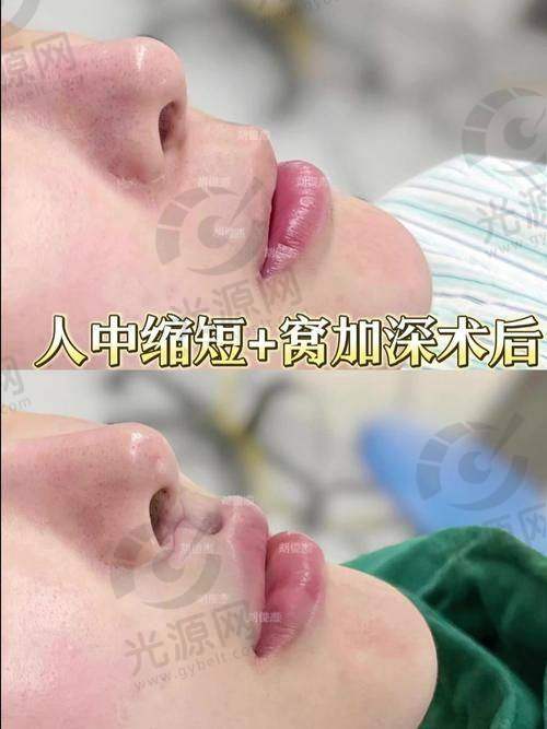 无痕人中缩短术的手术方法