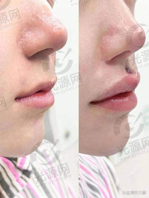无痕人中缩短术的术后修复情况