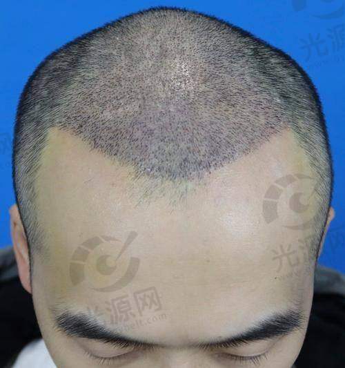 三、碧莲盛植发口碑如何？用户真实实例分享