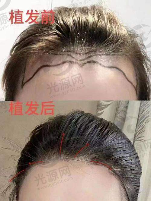 一、具有影响力与实力兼具的四川华 西医院植发地址