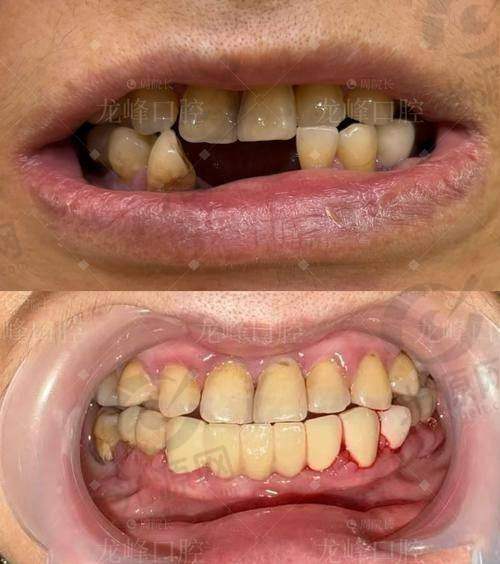 烤瓷牙的特点与费用