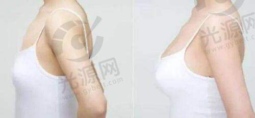 做胸什么品牌假体更好——宝俪