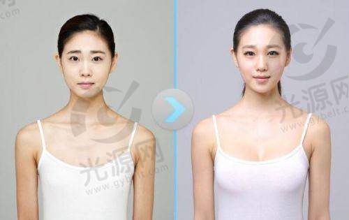 总结：做胸什么品牌假体更好