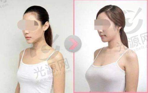 做胸什么品牌假体更好——傲诺拉