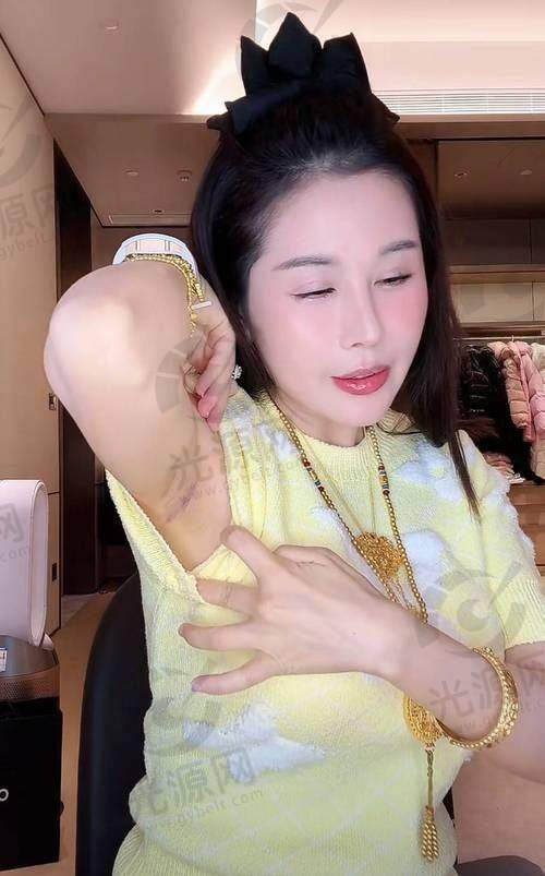 做胸什么品牌假体更好——法芮娅