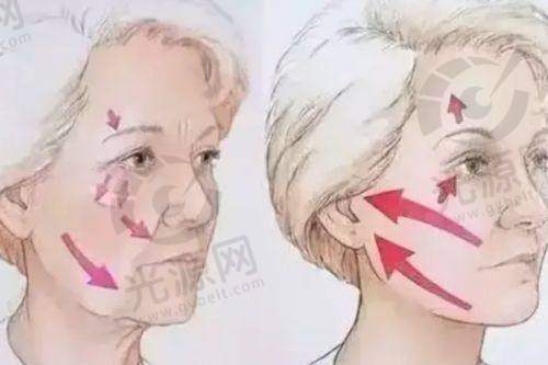 整体面部年轻化的至佳方案