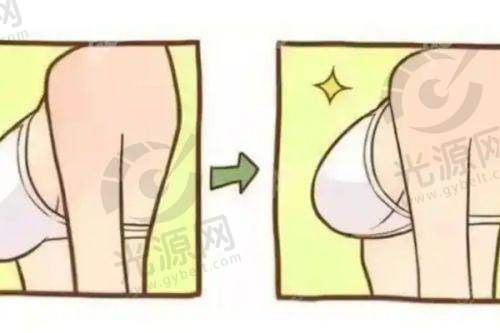曼特波假体缺点