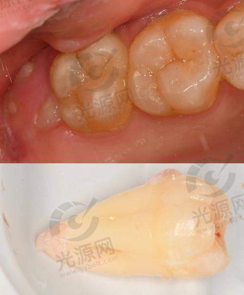 智齿冠周炎疼痛的处理应对
