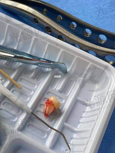 结论：智齿冠周炎能自愈吗？