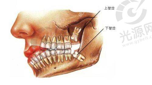实例分析：智齿冠周炎的成功治疗经验