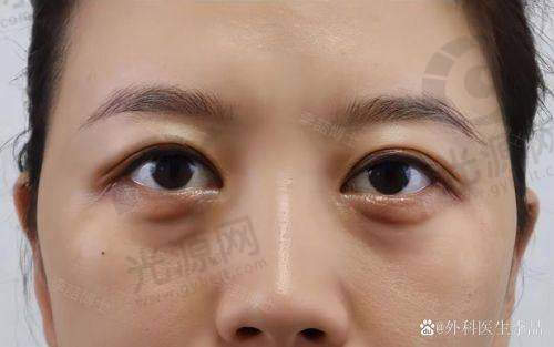 美人鱼去眼袋 专项技术的原理与成分
