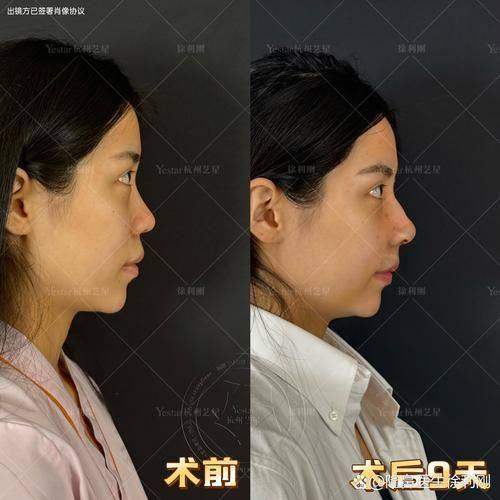 塑形技术与肋骨鼻发白的潜在影响