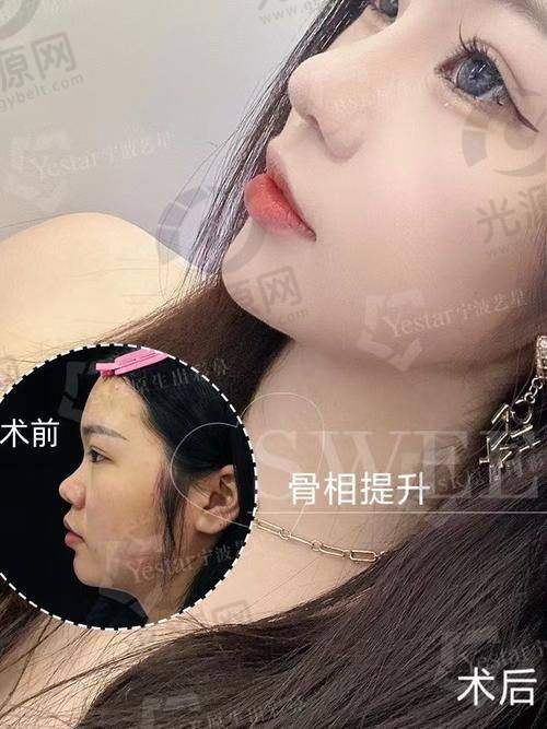 肋骨鼻发白现象对应的治疗方法
