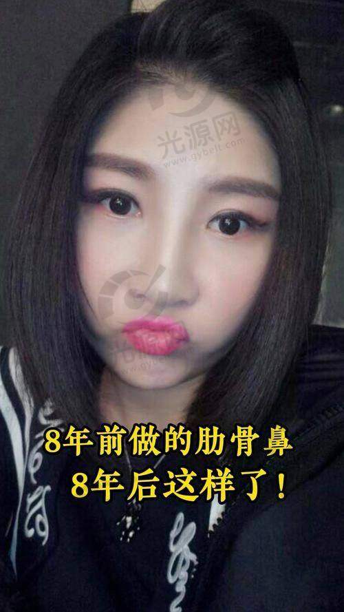 肋骨鼻迭代反应导致鼻尖白点