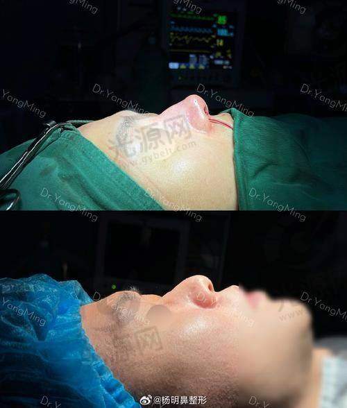 肋骨鼻3年鼻尖突然出现了白点是穿孔吗？